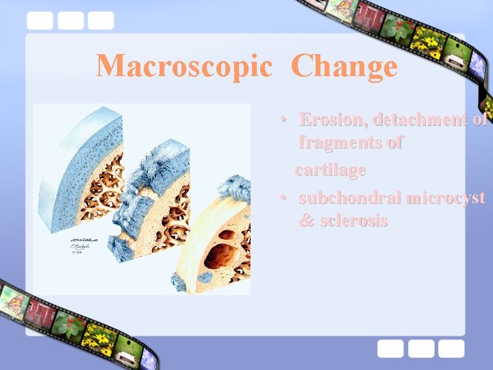 Macroscopic Change • Erosion, detachment of fragments of cartilage • subchondral microcyst & sclerosis