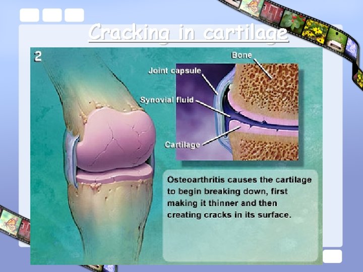 Cracking in cartilage 