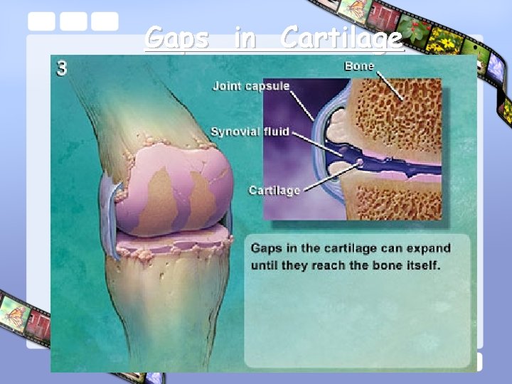 Gaps in Cartilage 