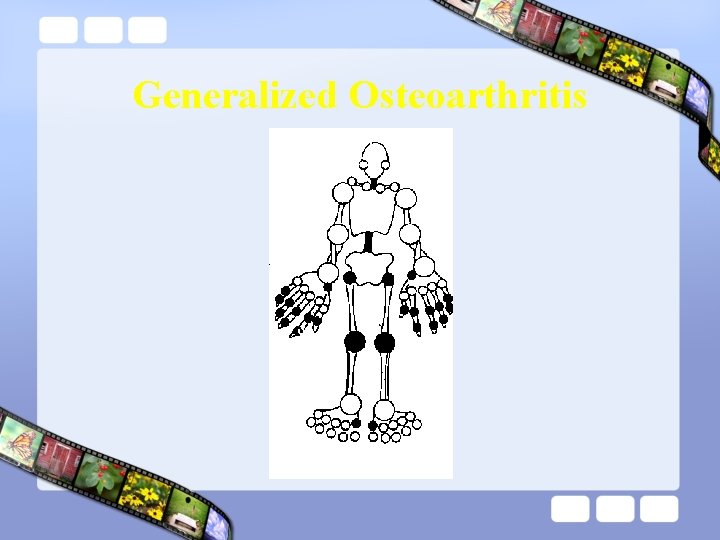 Generalized Osteoarthritis 