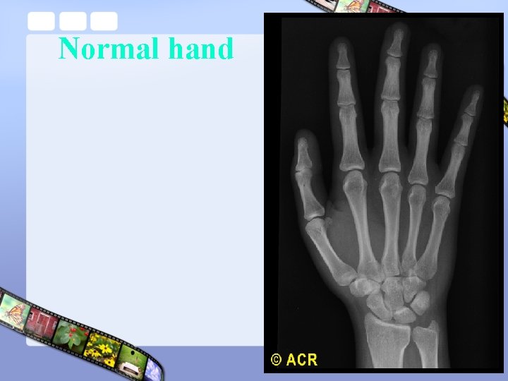 Normal hand 