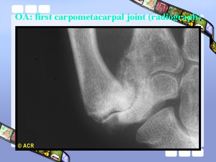 OA: first carpometacarpal joint (radiograph) 