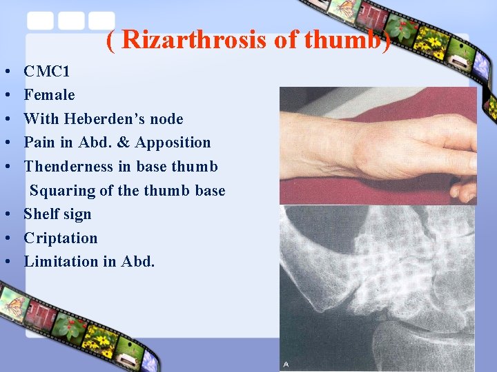 ( Rizarthrosis of thumb) • • • CMC 1 Female With Heberden’s node Pain