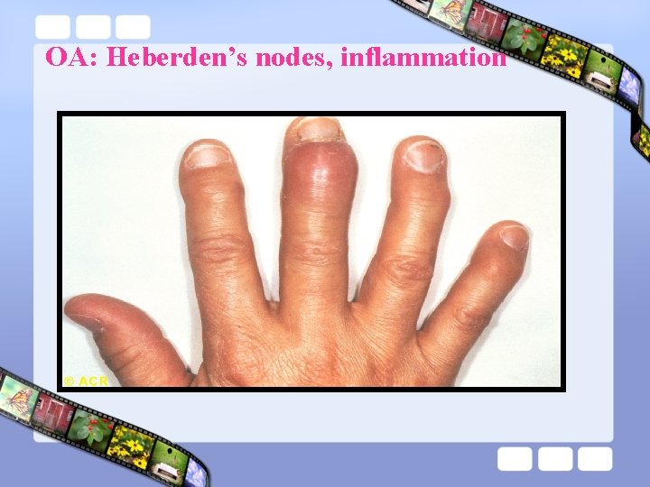 OA: Heberden’s nodes, inflammation 