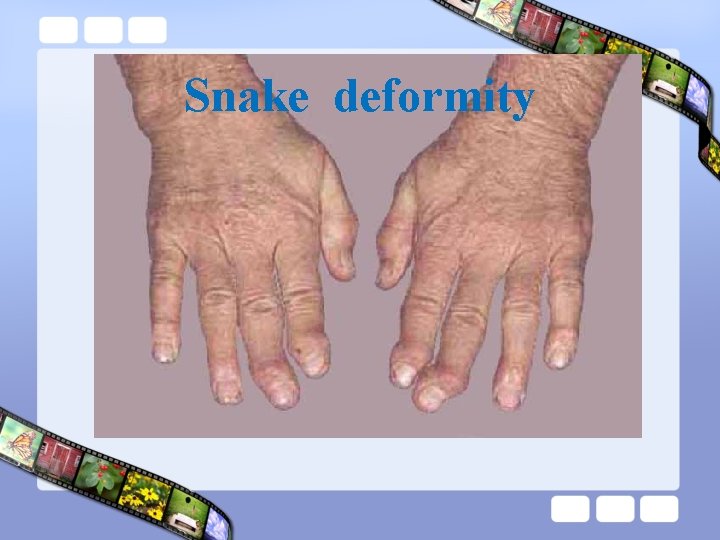 Snake deformity 