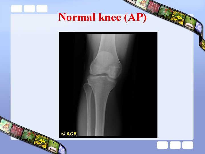 Normal knee (AP) 