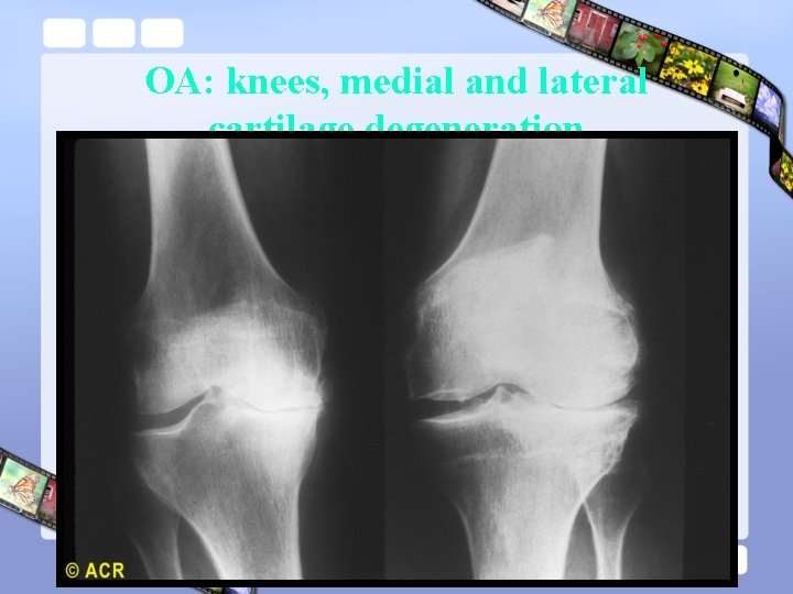 OA: knees, medial and lateral cartilage degeneration 