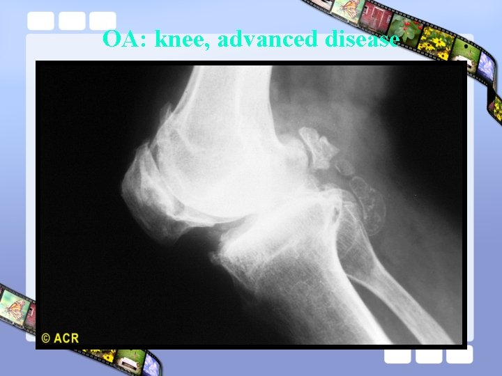 OA: knee, advanced disease 