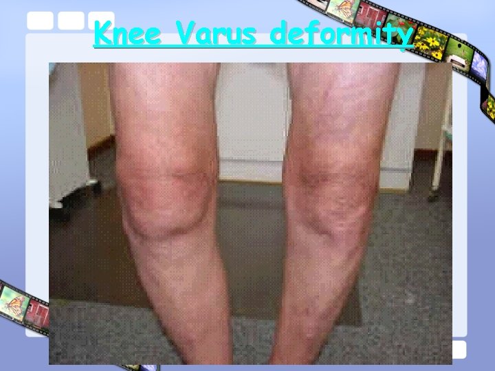 Knee Varus deformity 