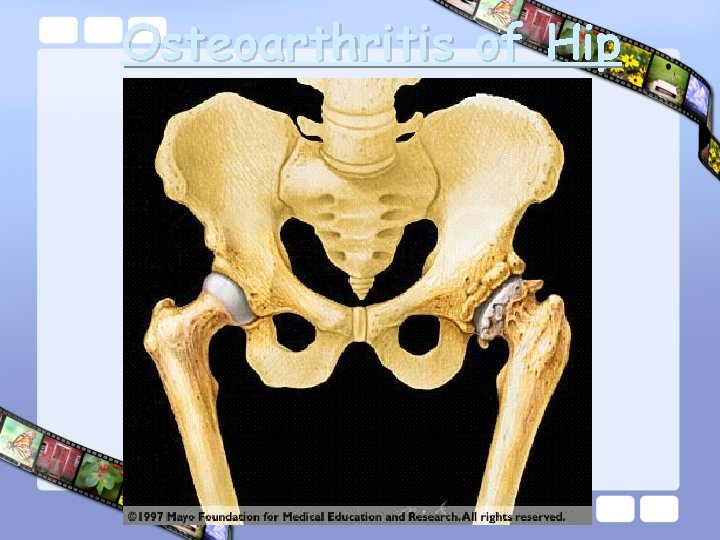 Osteoarthritis of Hip 