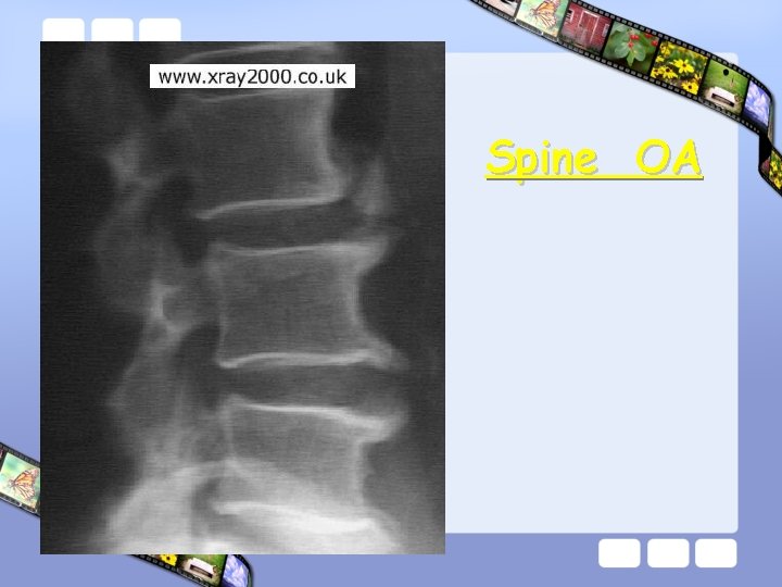 Spine OA 