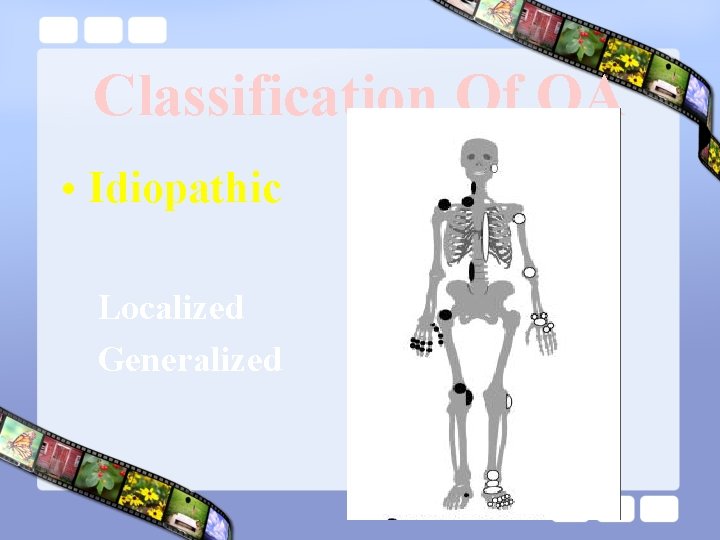 Classification Of OA • Idiopathic Localized Generalized 