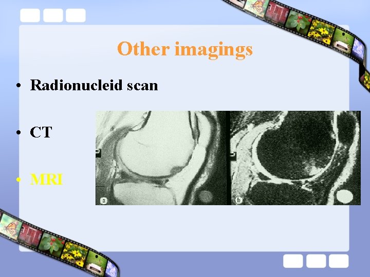 Other imagings • Radionucleid scan • CT • MRI 