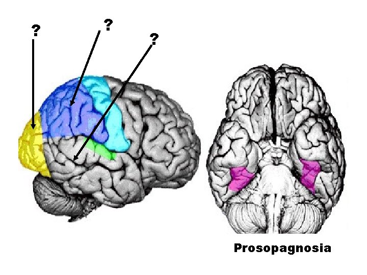 ? ? ? Prosopagnosia 