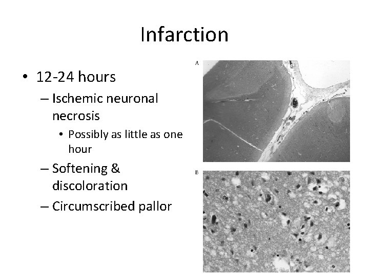 Infarction • 12 -24 hours – Ischemic neuronal necrosis • Possibly as little as