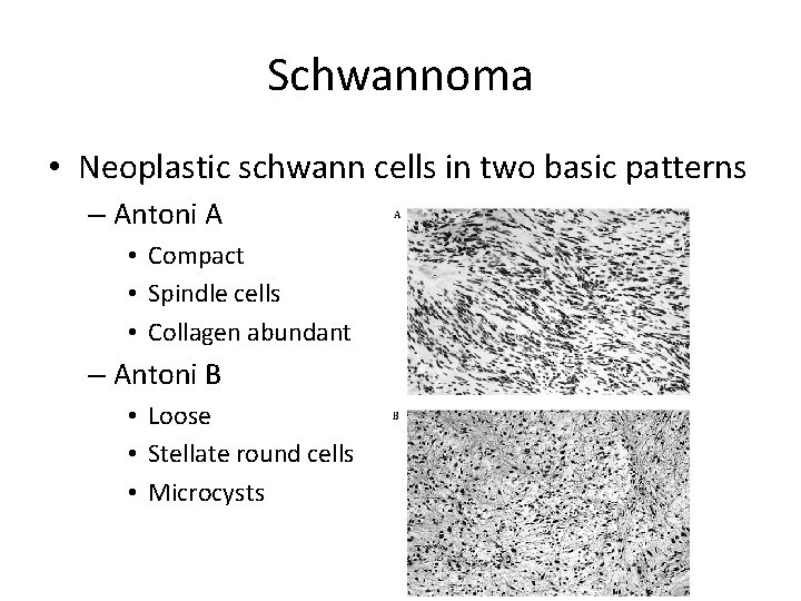 Schwannoma • Neoplastic schwann cells in two basic patterns – Antoni A • Compact