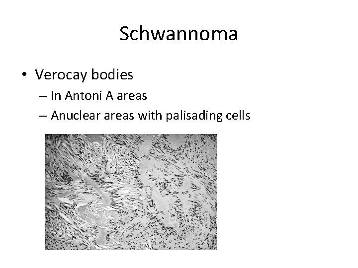 Schwannoma • Verocay bodies – In Antoni A areas – Anuclear areas with palisading