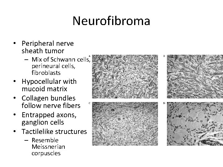 Neurofibroma • Peripheral nerve sheath tumor – Mix of Schwann cells, perineural cells, fibroblasts