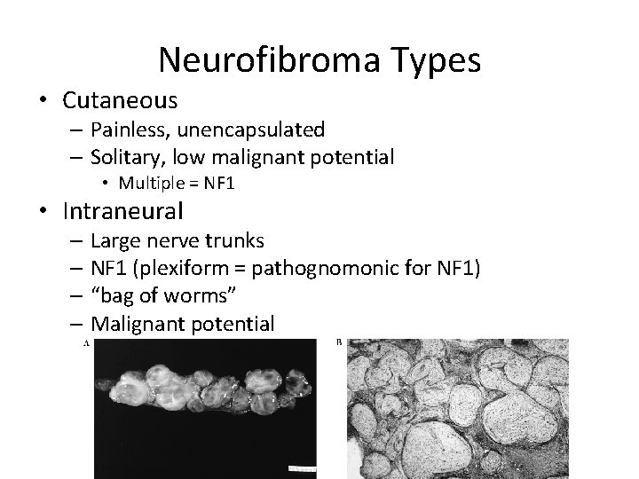 Neurofibroma Types • Cutaneous – Painless, unencapsulated – Solitary, low malignant potential • Multiple