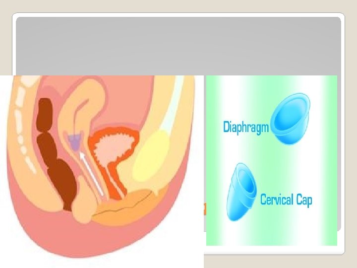 2 pessarium (diafragma vaginal dan carnival cap). 