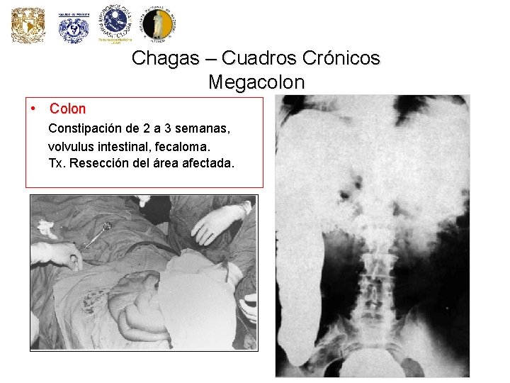 Chagas – Cuadros Crónicos Megacolon • Colon Constipación de 2 a 3 semanas, volvulus Chagas – Cuadros Crónicos Megacolon • Colon Constipación de 2 a 3 semanas, volvulus