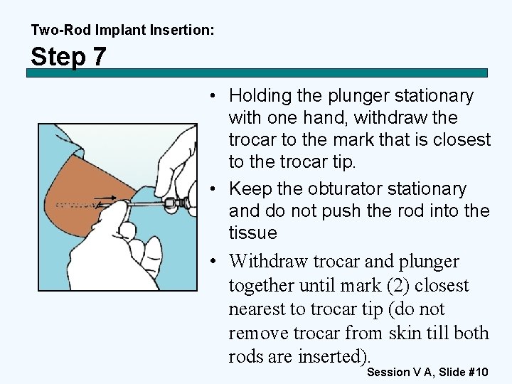 Two-Rod Implant Insertion: Step 7 • Holding the plunger stationary with one hand, withdraw