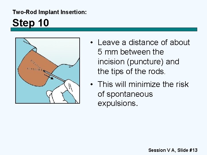 Two-Rod Implant Insertion: Step 10 • Leave a distance of about 5 mm between