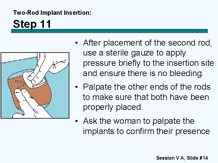 Two-Rod Implant Insertion: Step 11 • After placement of the second rod, use a