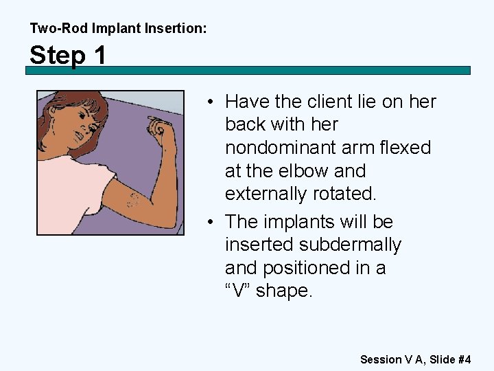 Two-Rod Implant Insertion: Step 1 • Have the client lie on her back with