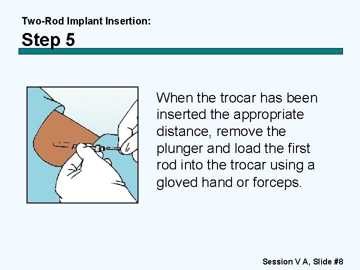 Two-Rod Implant Insertion: Step 5 When the trocar has been inserted the appropriate distance,