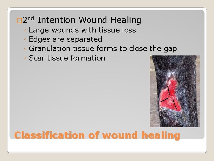 � 2 nd Intention Wound Healing ◦ Large wounds with tissue loss ◦ Edges