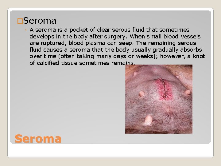 �Seroma ◦ A seroma is a pocket of clear serous fluid that sometimes develops