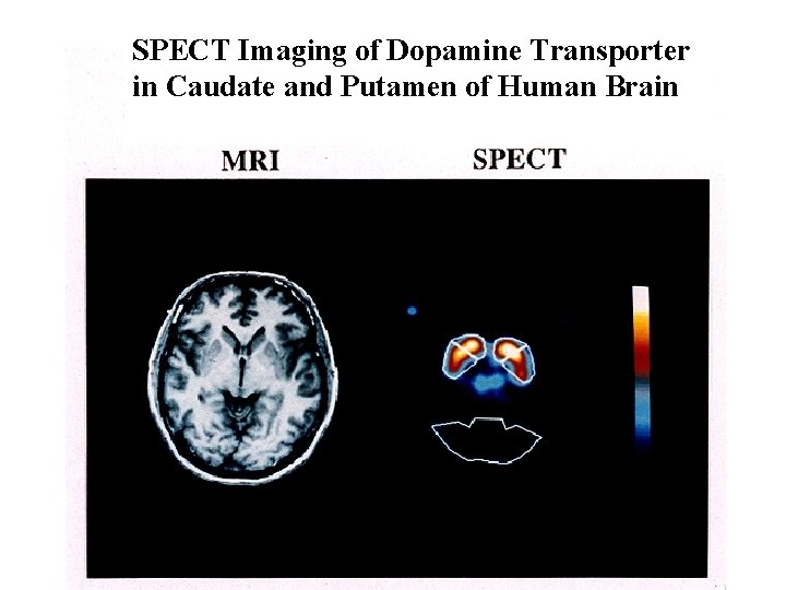 SPECT Imaging of Dopamine Transporter in Caudate and Putamen of Human Brain 