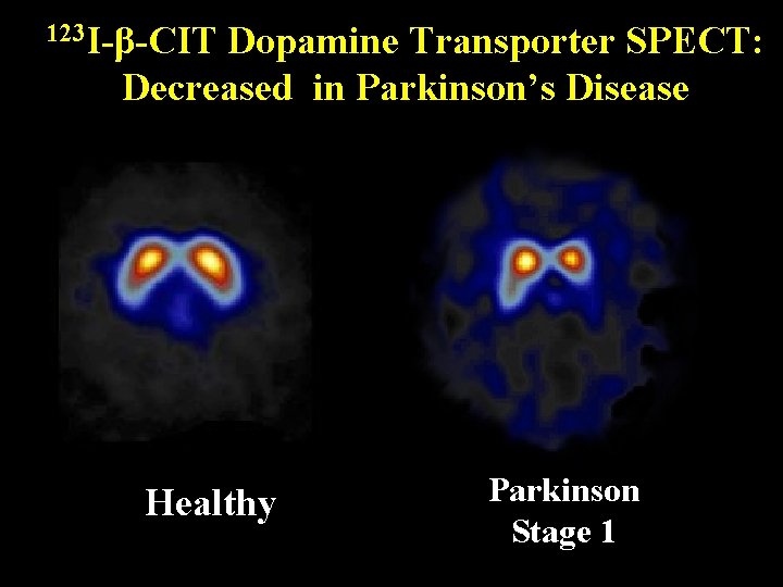 123 I-β-CIT Dopamine Transporter SPECT: Decreased in Parkinson’s Disease Healthy Parkinson Stage 1 