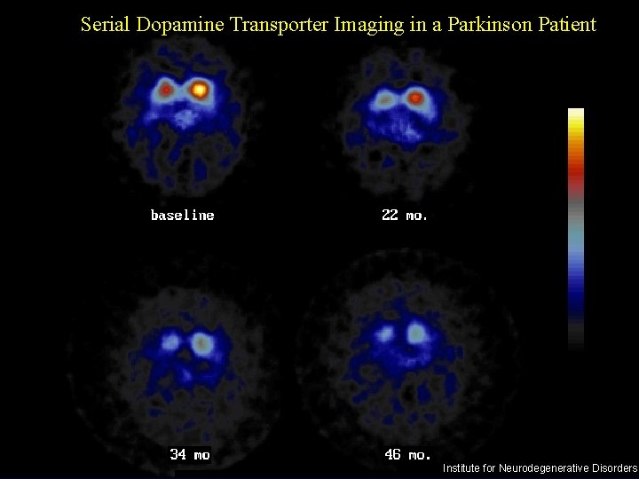 Serial Dopamine Transporter Imaging in a Parkinson Patient Institute for Neurodegenerative Disorders 