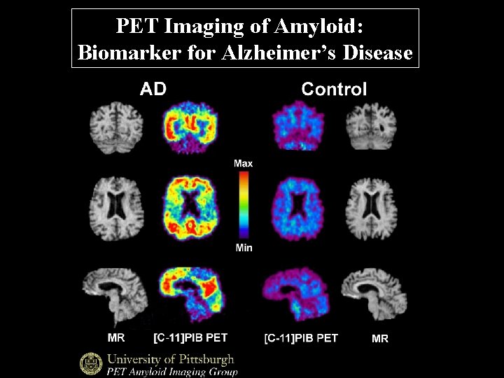 PET Imaging of Amyloid: Biomarker for Alzheimer’s Disease 