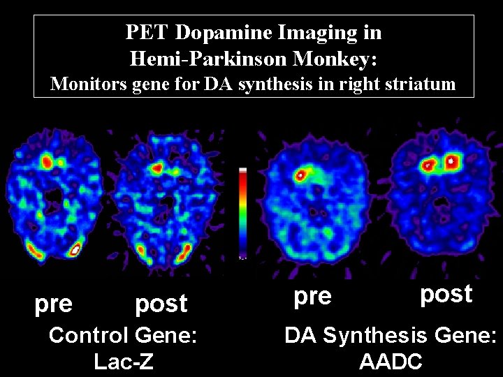 PET Dopamine Imaging in Hemi-Parkinson Monkey: Monitors gene for DA synthesis in right striatum