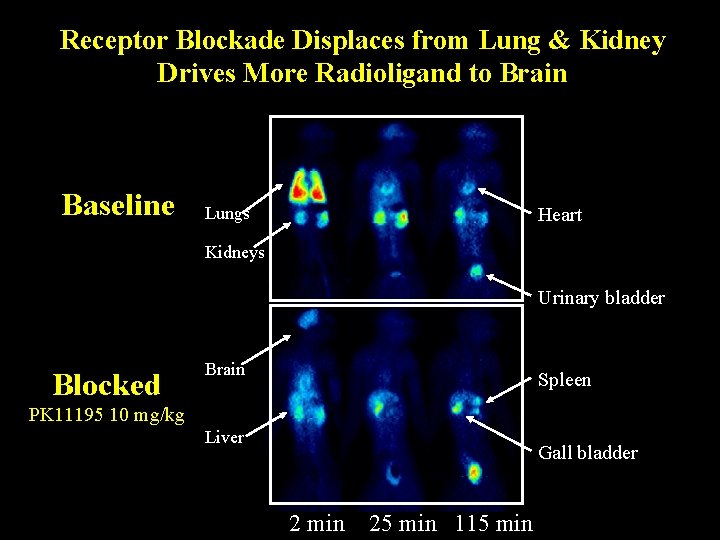 Receptor Blockade Displaces from Lung & Kidney Drives More Radioligand to Brain Baseline Lungs