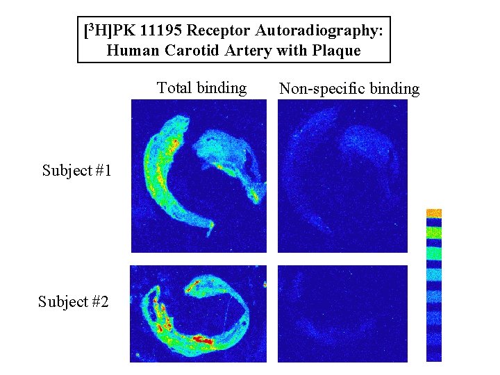 [3 H]PK 11195 Receptor Autoradiography: Human Carotid Artery with Plaque Total binding Subject #1