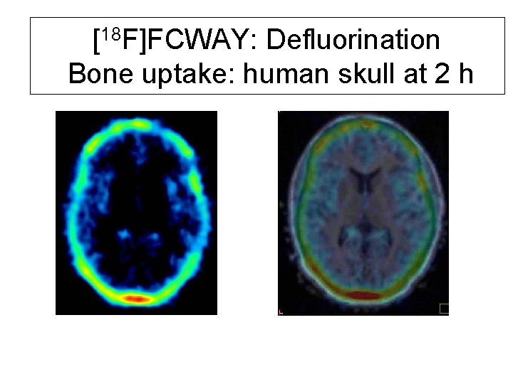 [18 F]FCWAY: Defluorination Bone uptake: human skull at 2 h 