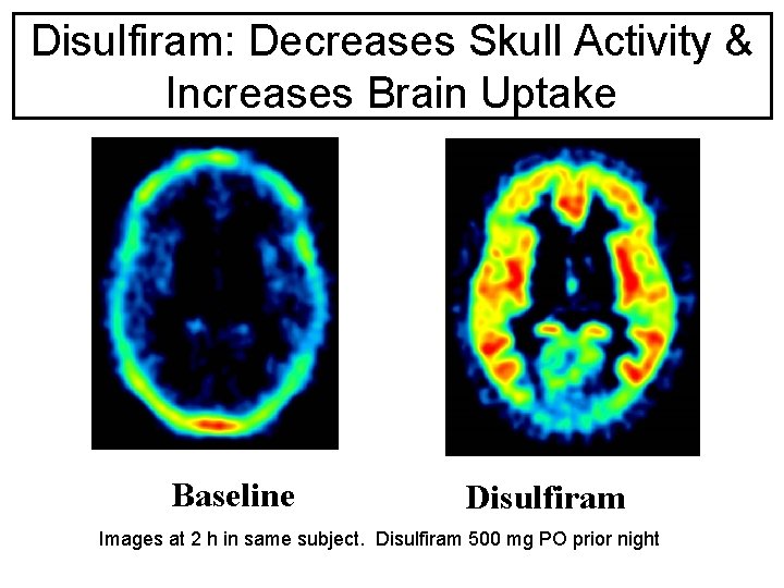 Disulfiram: Decreases Skull Activity & Increases Brain Uptake Baseline Disulfiram Images at 2 h