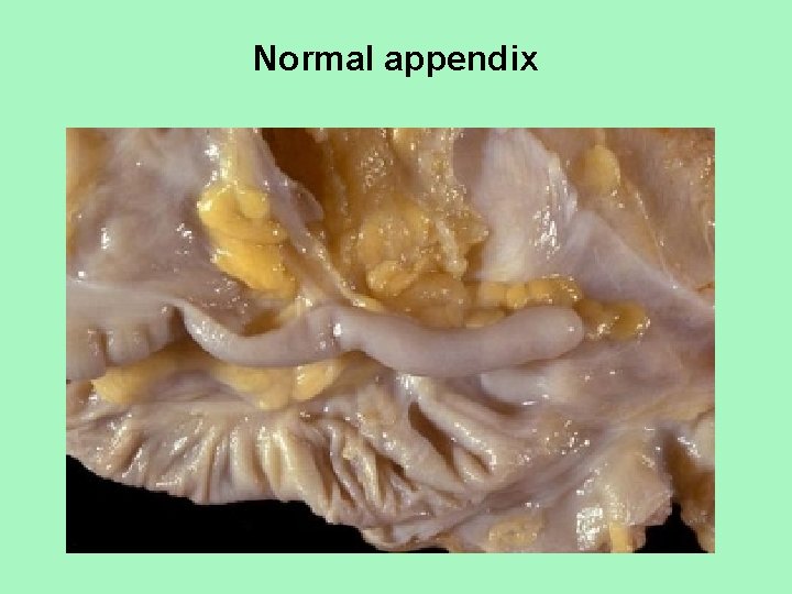 Normal appendix 