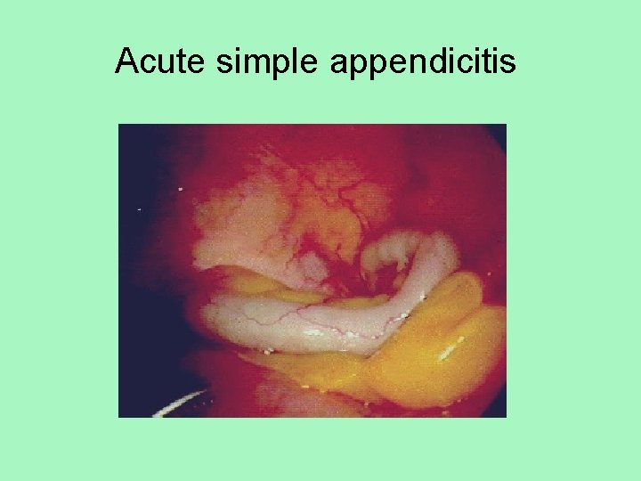 Acute simple appendicitis 