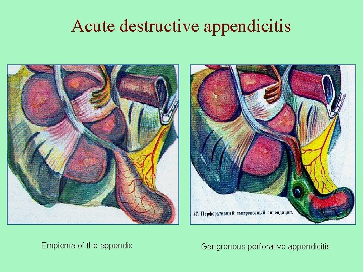 Acute destructive appendicitis Empiema of the appendix Gangrenous perforative appendicitis 