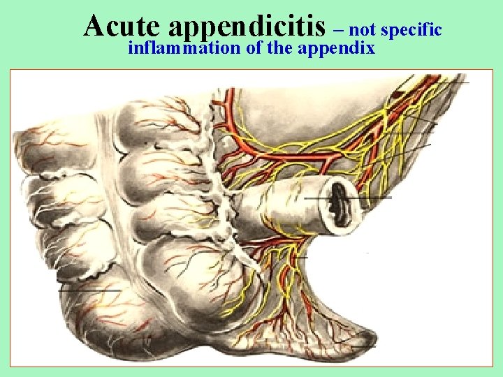 Acute appendicitis – not specific inflammation of the appendix 