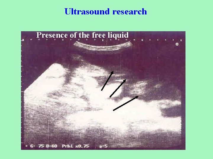 Ultrasound research Presence of the free liquid 