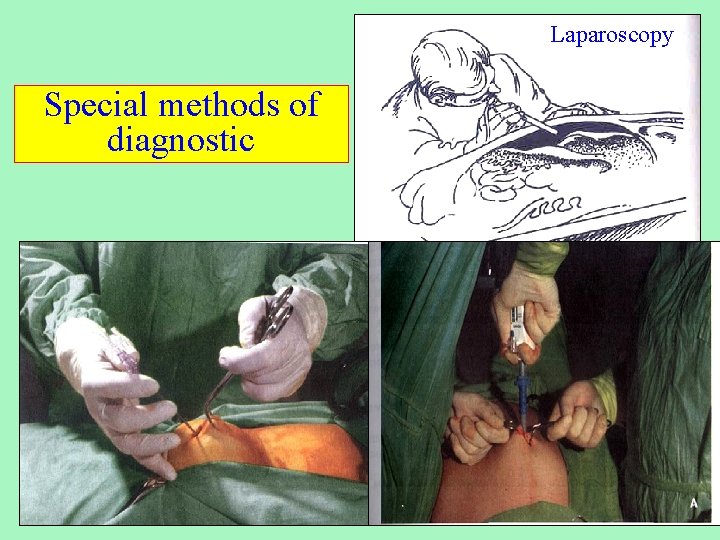 Laparoscopy Special methods of diagnostic 