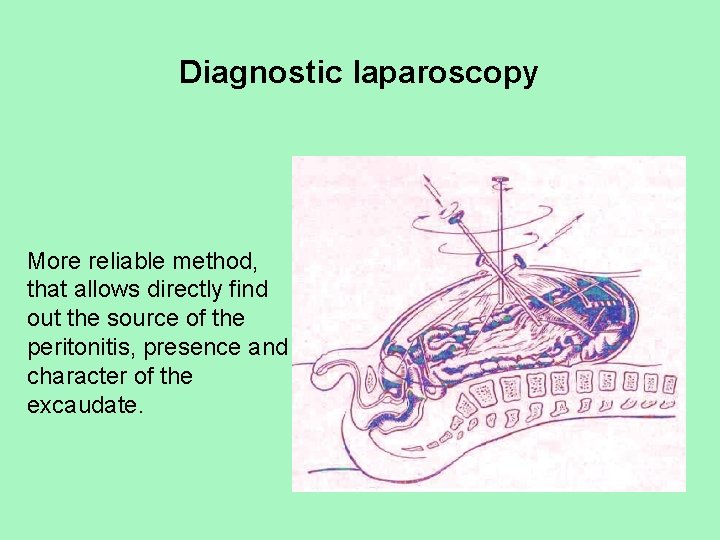 Diagnostic laparoscopy More reliable method, that allows directly find out the source of the