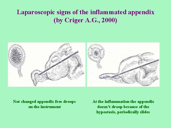 Laparoscopic signs of the inflammated appendix (by Criger А. G. , 2000) Not changed