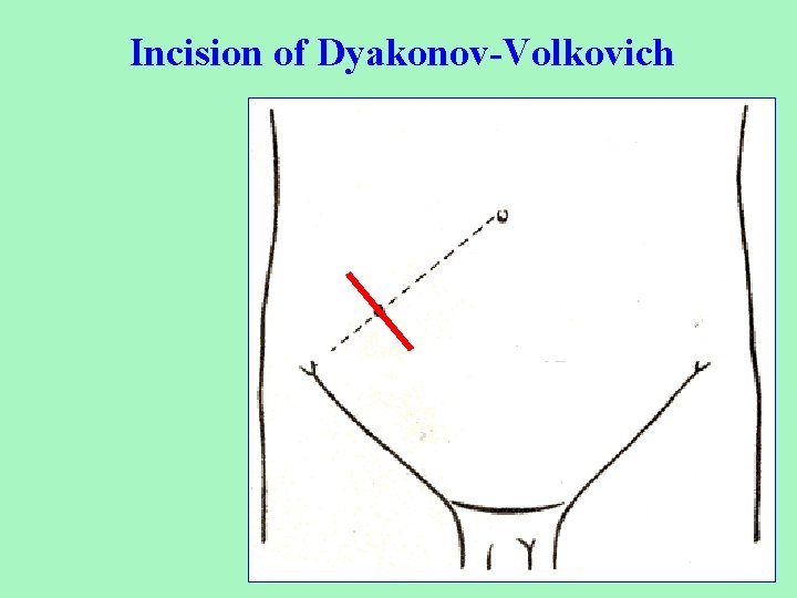 Incision of Dyakonov-Volkovich 